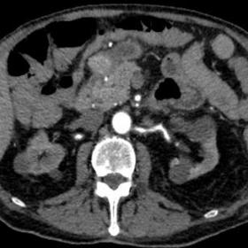 Abdominal axial IVC Angio-CT scan, arterial phase that shows a contrast enhancing 13mm spherical lesion located on the horizo