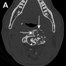 (A, B) Axial and sagittal non-contrast CT images show a mass at the level of the second and third cervical vertebra (C2, C3) 