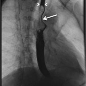 X-ray esophageal transit with water-oral contrast media shows a delayed transit with endoluminal stasis (arrowheads) and a fi