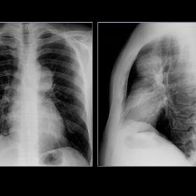 Chest X-Ray (PA & Lateral):  A medium mediastinum mass was visualized. No additional findings were observed.