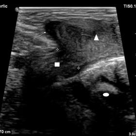 Depiction of the peritoneal breach with herniated (left) fallopian tube (square) and uterus (triangle) , positioned superolat