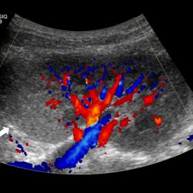 Colour-doppler ulltrasound scan showed increased echogenicity and vascular defect of the upper pole of the right kidney (arro
