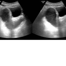 US figure shows a cystic pouch-like structure posterior to the bladder and anterior to the rectum, containing heterogeneous f