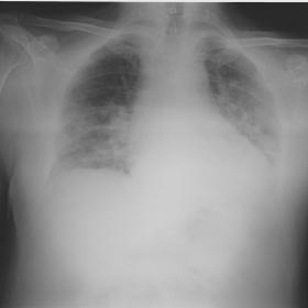 Chest X-ray showing patchy airspace opacities in both basal and central pulmonary areas