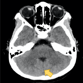 Axial non-enhanced CT at the level of the pons shows no cerebellar vermis at its expected location (arrow).
