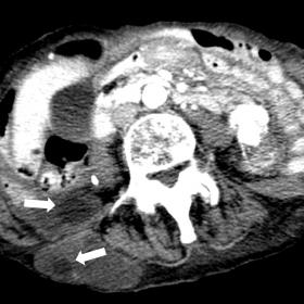 Soft tissue window pelvic CT shows some daughter vesicles inside of the hydatidic cysts (white arrow), just next to the iliac