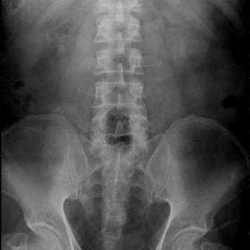 Plain x-ray shows radioopacity in the renal region bilaterally suggesting renal stones.