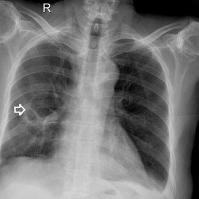 Chest X-ray PA view showing thin walled cavitary lesion in the right mid zone (white arrow) with adjacent airspace opacity. N