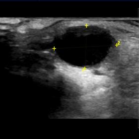 Ultrasound scan of the palpable mass in right preauricular area revealed an anechoic cystic