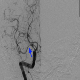 Right ICA run on cerebral angiogram showed stenosis of right M1 segment and supraclinoid portion of right ICA.