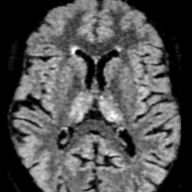 Axial FLAIR image of the brain shows well demarcated symmetrical abnormal high signal in both thalami