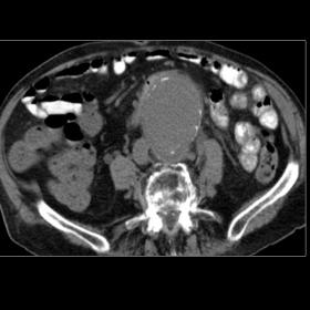 Basal CT (axial projection). A huge 74 mm transverse diameter infrarenal aortic aneurysm was observed. It showed intimate con