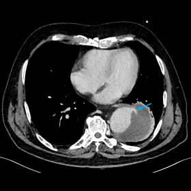 Contrast-enhanced chest CT (axial). Thoracic aorta aneurysm with an inner thrombus and contrast extravasation in the center, 