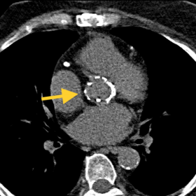 Axial non-enhanced ECG-gated thoracic CT performed 8 months previously to the patient’s hospital admission. Aortic suturele