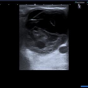 Ultrasound showed a large, 7 × 6 cm, circumscribed, lobulated, and anechoic cystic collection with septations located in the