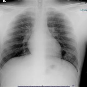 Case 1 –  Chest X-Ray: two ill-defined parenchymal opacities in the left medium-lower lung. No pleural effusion.