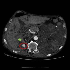 Abdominal computed tomography scan showed a retroperitoneal hematoma (green star) and a round collection of high-density suggestive of pseudoaneurysm (red ellipse) from the right middle adrenal artery.