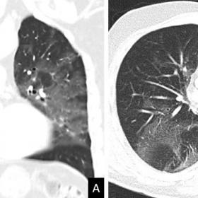 Severe presentation of COVID-19 pneumonia on chest CT. Coronal (A) and transverse (B) images reveal bilateral, multifocal, an