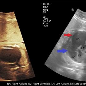 On ultrasound, enlarged right atrium is seen on apical four chamber view (red arrow) and fetal echo (black arrow) with inferi