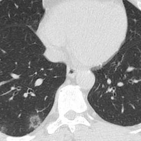 Figure1-5 Axial plain CT chest images show small focal areas of subpleural and bronchocentric opacities and ground glass atte