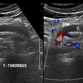 Gray scale and color Doppler ultrasound images of abdomen showing thrombus in proximal SMA.