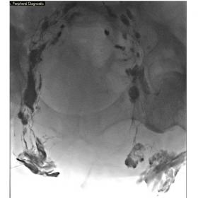 Lymphangiogram by bilateral inguinal intranodal infusion of Lipiodol (0.2 ml/min on each side) via 25-gauge spinal needles (s