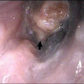 Upper gastrointestinal endoscopy revealed large exophytic, irregular and brownish tumour (arrow).