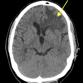 Axial non-enhanced CT of the head shows vasogenic edema with hypodensity in the anterior left frontal lobe.
