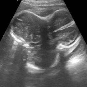 Ultrasound findings of 5 month pregnant female shows classical clover shaped deformity of fetal skull.