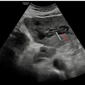 Greyscale US (A, C) images showing a moderately hypoechoic periportal cuffing (white arrows) from the hilum towards the perip