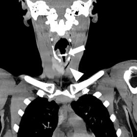 CT in a coronal reconstruction showing a hyperdense (calcium) object (arrow) lodged in the upper airway as well as free air i
