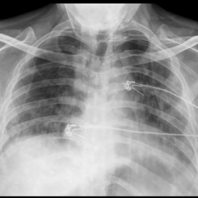 X-ray chest (frontal view) on day 1. Depicting inhomogeneous air space opacities in bilateral lung fields with a basal predom