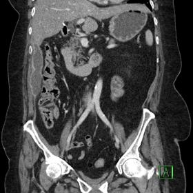 Coronal CT demonstrates an extensive longitudinal right peritoneal and paracolic gutter collection with wall enhancement and 