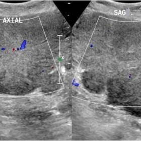 US image (axial and sagittal)  shows a large heterogeneously hyperechoic mass with vascularity within on Color Doppler.