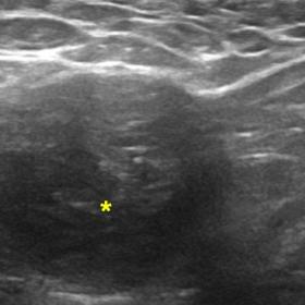 B-Mode ultrasound of right inguinal region showing (a) 2.5-cm heterogeneous, multilobulated, and well-defined mass with rounded contours [asterisk] and (b) no remarkable vascularization by colour Doppler.
