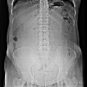 Plain abdominal radiograph, anteroposterior projection showing an ill-defined mass lesion along the right lumbar region and i