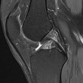 Sagittal PD FS image of the knee shows thickened ACL with diffuse hyperintensity giving rise to a ‘celery stalk’ appearan