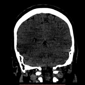 Coronal CT scan on 1-st day. Large hypo dense lesion in the lower part of the temporal lobe is visible on the right side.