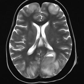 Axial T2 weighted image shows hyperintense areas predominantly involving cortex and subcortical white matter of bilateral fro