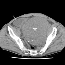 Pelvic mass (star) measuring 11 x 14 x 11 cm, situated in the retroperitoneal to the left of the bladder. The bladder and the