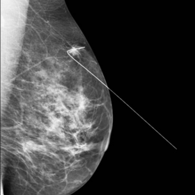 MLO (a) and CC (b) mammographic views showing a spiculated lesion in the upper outer quadrant of the left breast. There is as