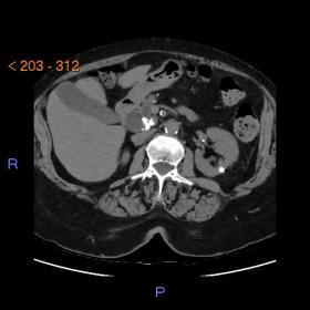Axial CT scan (a) shows gross calcifications in the head of the Pancreas and a cyst (32 mm) in the body of Pancreas (b) with 