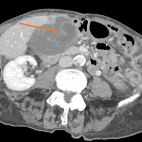 Axial slice of contrast-enhanced CT scan in portal venous phase shows distended gallbladder with thickened wall. The gallblad