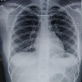 Initial X-ray chest postero anterior view shows a thin linear radio opaque foreign body lying along the course of left main b