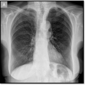 original (A) and illustrated (B) postero-anterior chest X-ray (A) show increased density and widening of the lower mediastinu