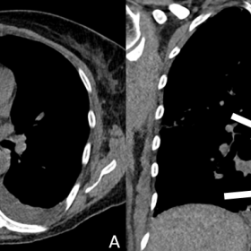 Unenhanced computed tomography (CT) 2 days before the onset symptoms. A, B. Revealed no significant findings, except for mild