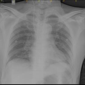Supine chest radiography AP view on the day of admission: Only transjugular central catheter noted in situ in right side with