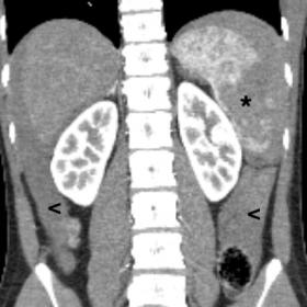 Coronal abdominal CT image (a) demonstrating Grade IV injury of the spleen (asterisk) and haemoperitoneum (arrowhead). Axial 