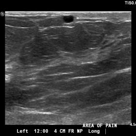 Sonographic examination of the left breast shows a dilated superficial vein with low-level echoes at the area of reported pai