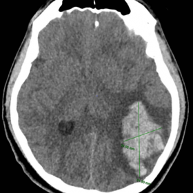 Axial Brain Non-enhanced CT: Depicts well defined area of hyperattenuation with peripheral vasogenic edema, epicenter in the 